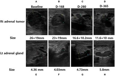 Case report: Successful medical management of adrenocortical carcinoma with metastasis in a Maltese dog